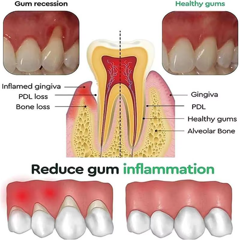 Gel Réparateur pour Gencives : Soulage les Douleurs, Améliore l'Inflammation des Gencives Abîmées, Nettoie les Taches Dentaires, Élimine le Tartre, Blanchit et Protège les Gencives